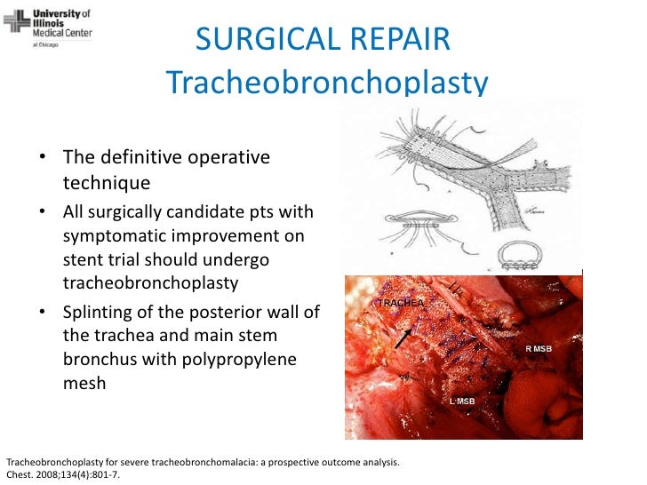 Dynamic Central Airway Obstruction Tracheomalacia, Tracheobronchomal…