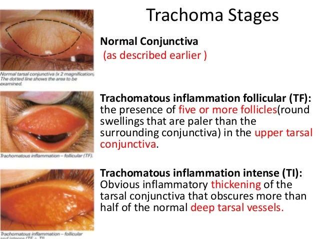 chlamydia vs gonorrhea symptoms chlamydia vs gonorrhea symptoms
