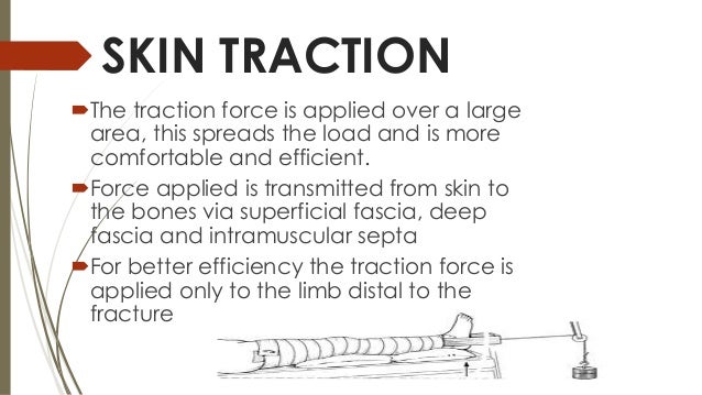 Traction(orthopedics)