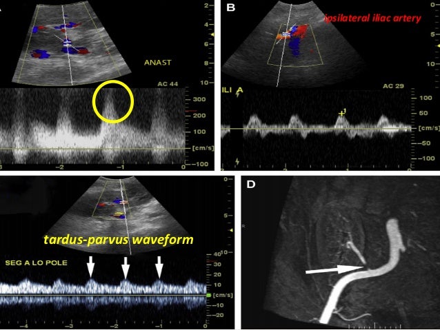 Transplant renal artery stenosis 2016