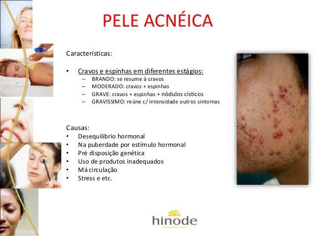 Pele depois de um acne de recém-nascidos