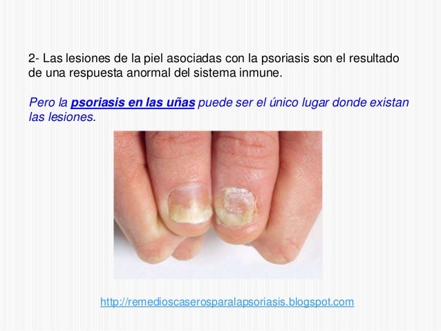 Las manchas blancas sobre las uñas de las manos de la causa y el tratamiento