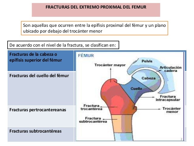 FRACTURAS DEL EXTREMO PROXIMAL DEL FEMUR