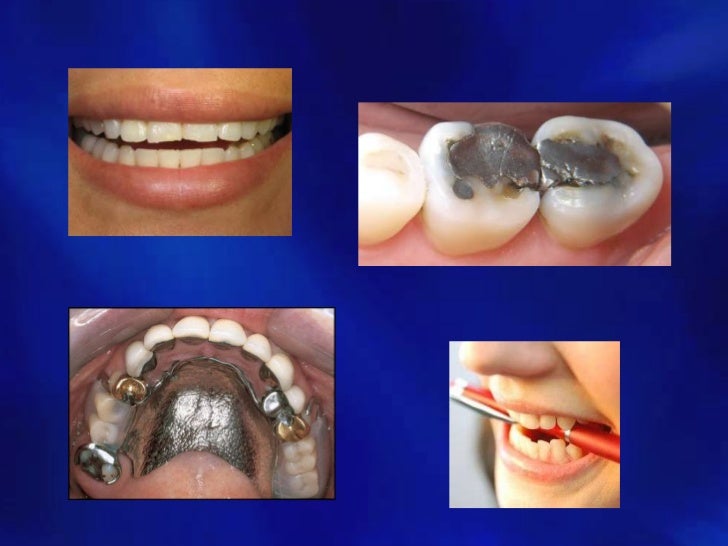 What Is Trauma Occlusion Ideas of Europedias