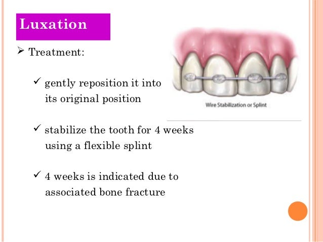 traumatic injuries of teeth tooth luxation