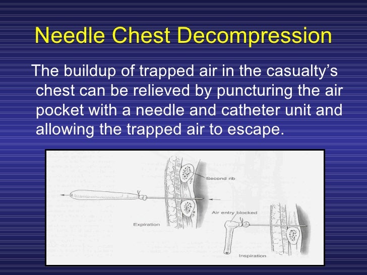 Treating Chest Trauma