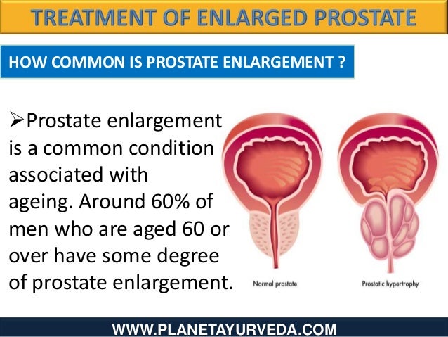 Does Propecia Prevent Enlarged Prostate