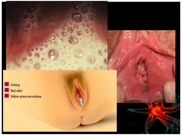 TRICONOMIASIS