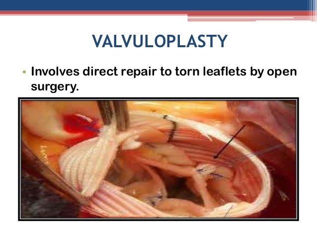 Tricuspid valve stenosis