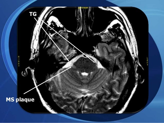 Trileptal For Ms Pain