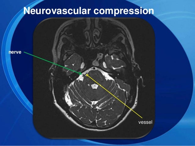 Trileptal For Ms Pain