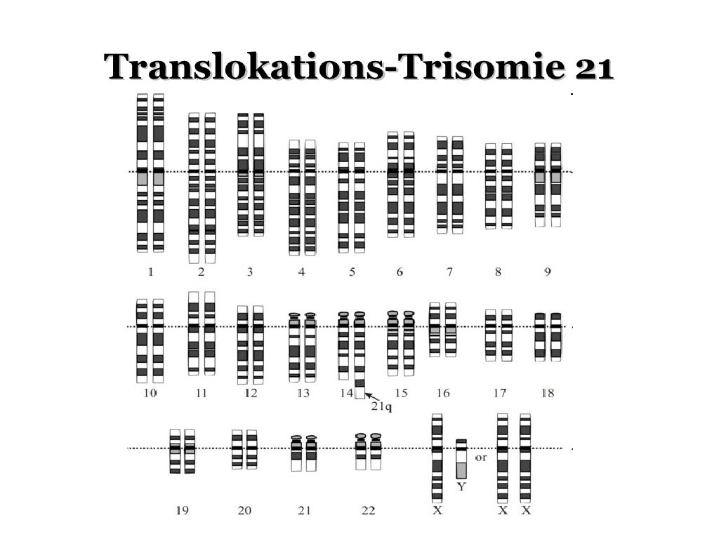 Trisomie 21