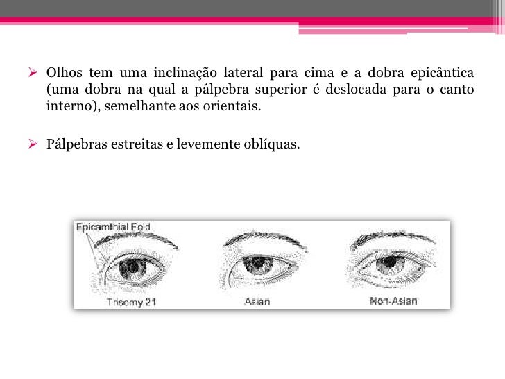 Trissomia 21 Trissomia 21