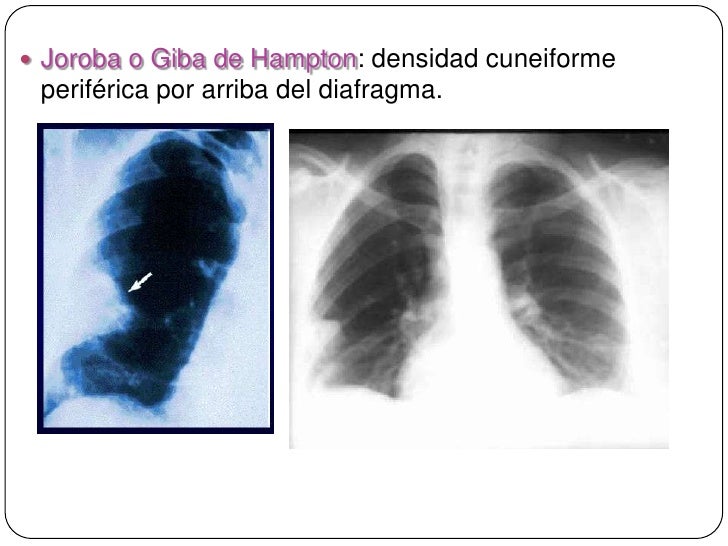 Tromboembolismo pulmonar Tromboembolismo pulmonar