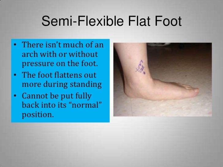 Flat Feet Treatment Options