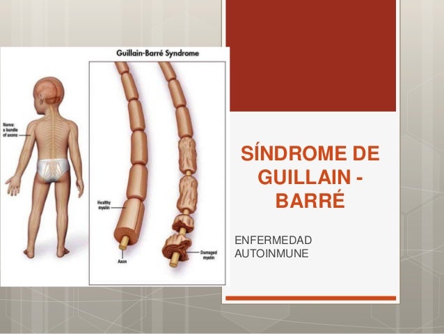 syndrome de guillain barre