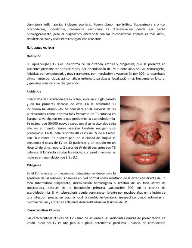 El vinagre de manzana de la eccema en las manos