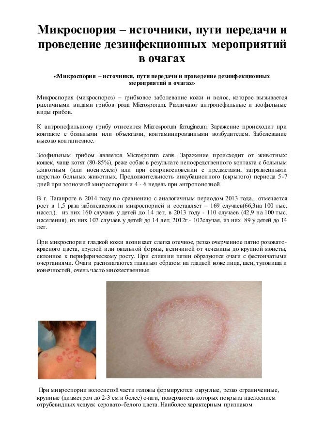 Лишай у детей и его уход Лишай у детей и его уход