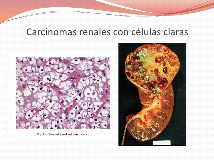 Tumores Renales