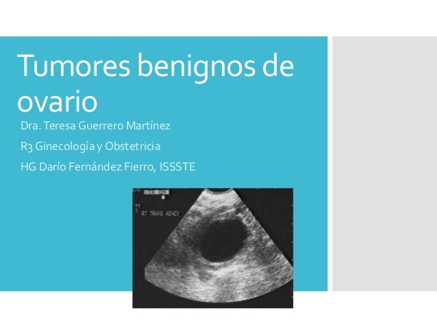 GINECOLOGIA TUMORES ginecologia tumores: