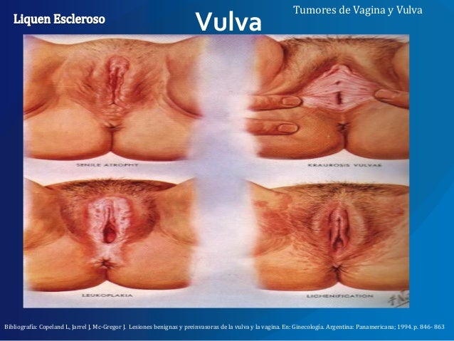 Vulvodynia: Causes, Symptoms, and Treatments - WebMD