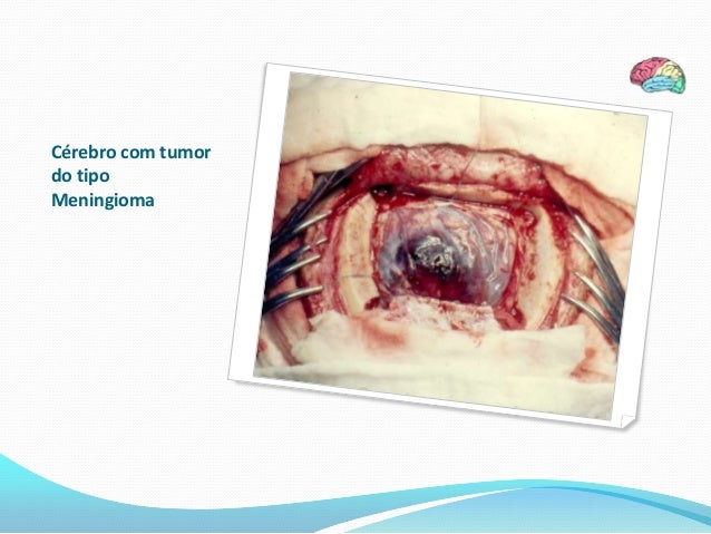 Radiothérapie anti inflammatoire chimiothérapie lv5fu2