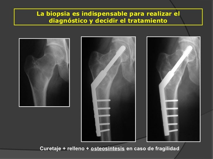 Hondroprotektory a la osteocondrosis la eficiencia