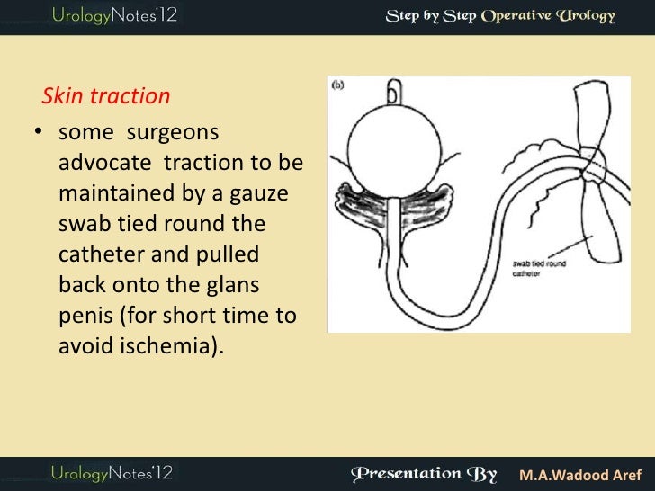 TURP step by step operative urology