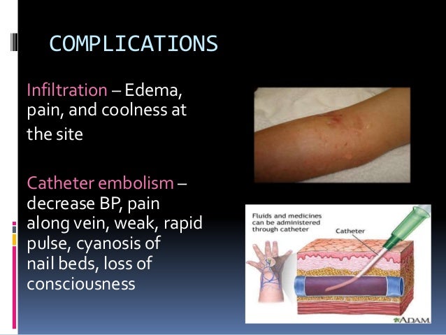 fluid overload iv complication fluid overload iv complication