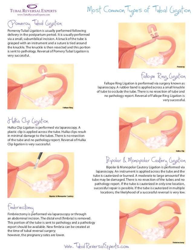 Ring Method Tubal Ligation Ring Method Tubal Ligation
