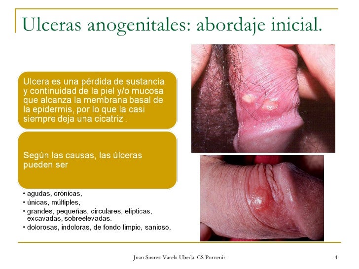 Fotos de ulceras en el pene Fotos de ulceras en el pene