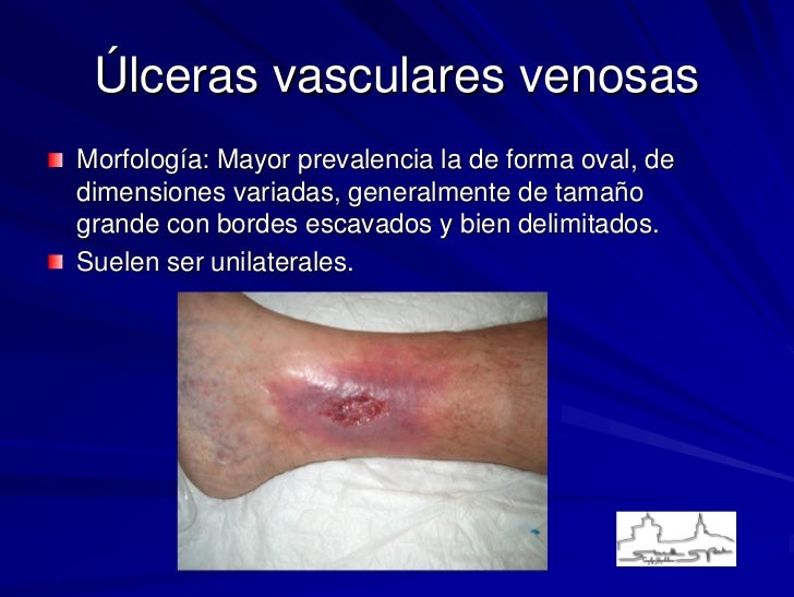La gangrena del intestino gordo a la trombosis