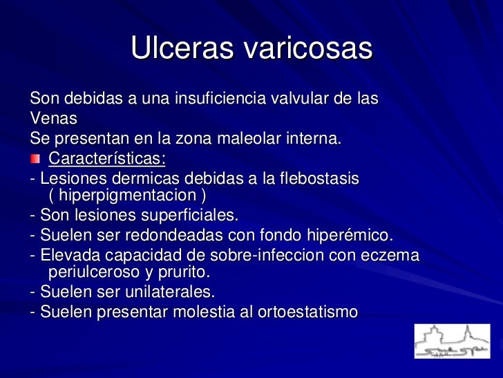 Varikoz zumban los pies