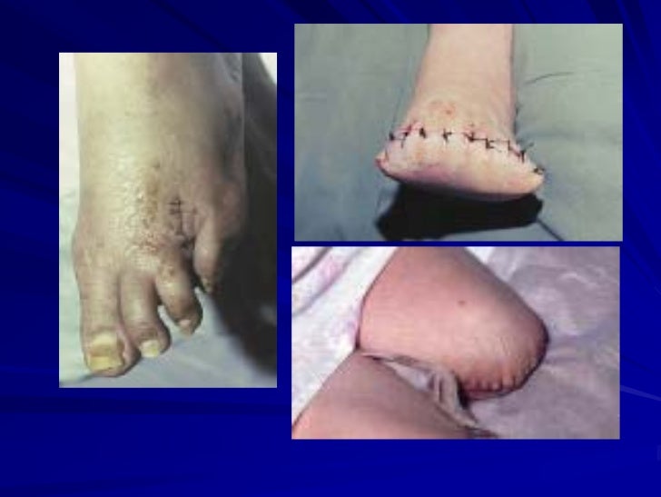La tromboflebitis de la mano después del cuentagotas el tratamiento