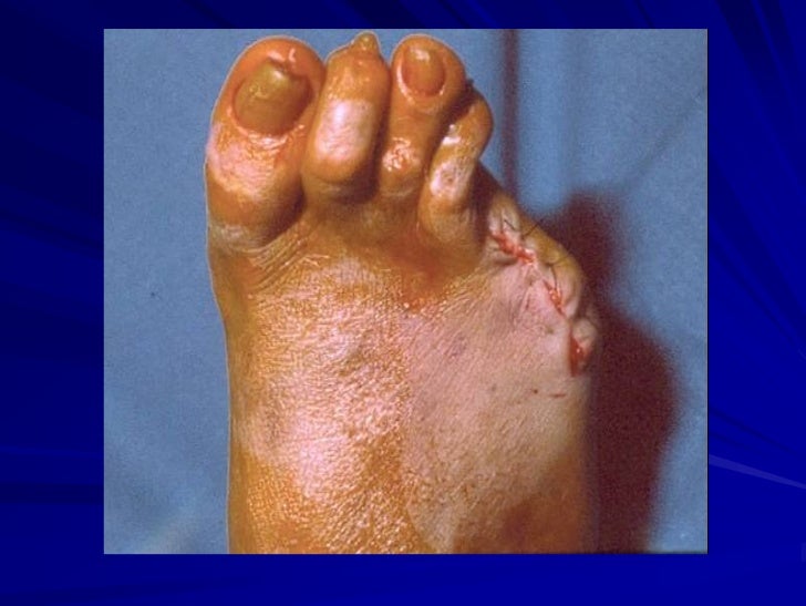 La diferencia flebologa del cirujano vascular