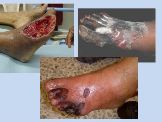 Si es posible usar el aceite de bardana a la psoriasis