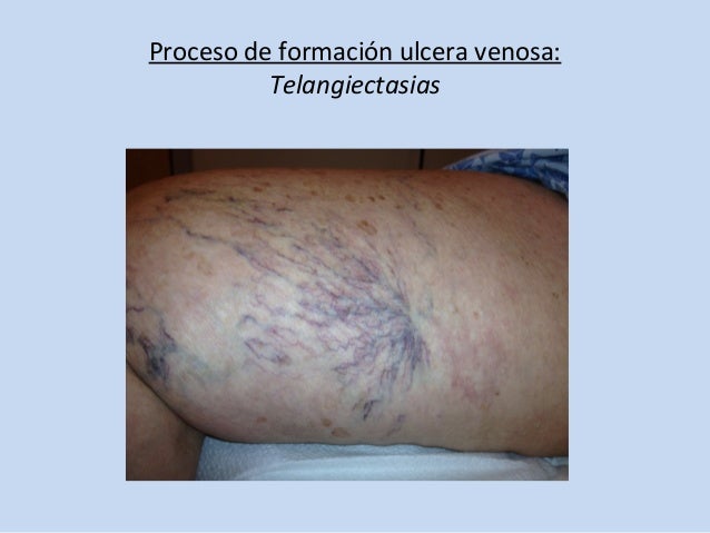 Neyrodermit los síntomas y el tratamiento el foro