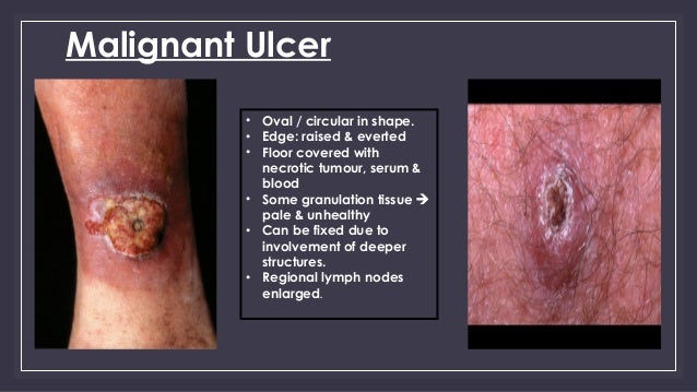 Treatment Options for Leg Ulcers | Smith & Nephew - Australia