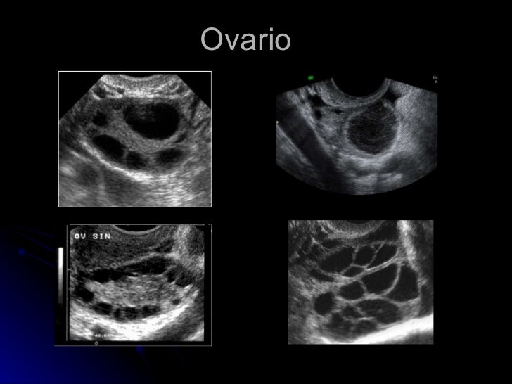 Ultrasonido pélvico