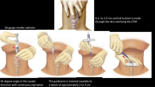 Watch What Is a Tracheostomy video Watch What Is a Tracheostomy video