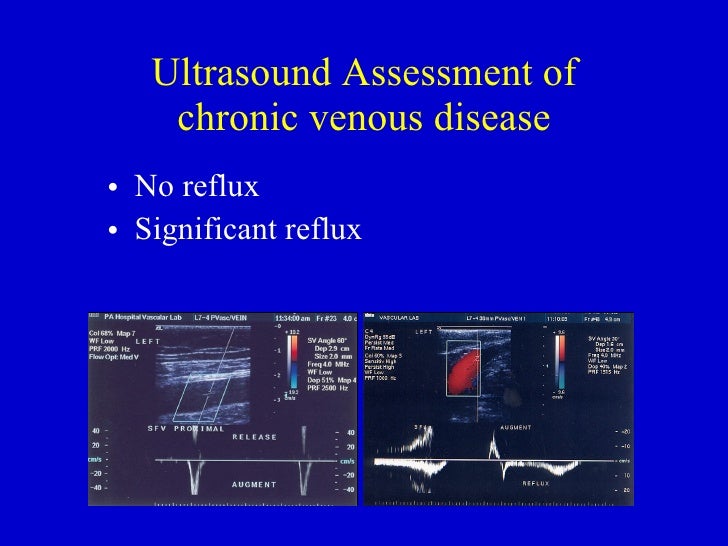 venous reflux ultrasound