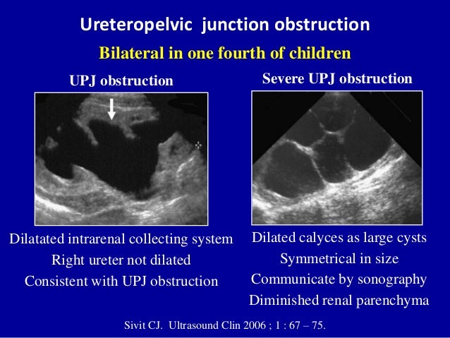 Bleeding Sinus Tract