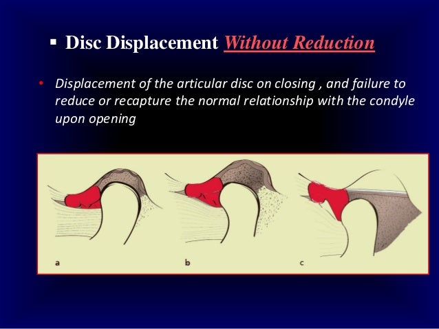 jaw reduction surgery