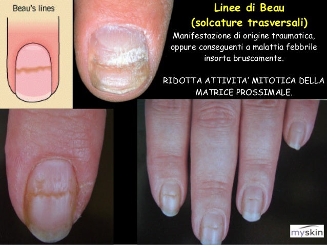 Eczema di disgidrotichesky su un dito di fotografia