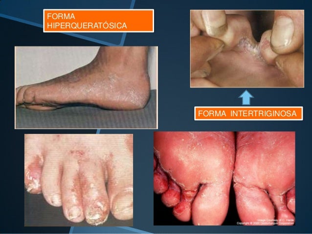 El hongo de las uñas la crema lamizil