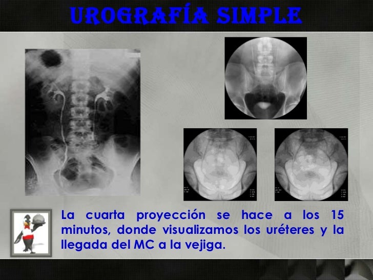 Como Se Hace Una Urografia Excretora