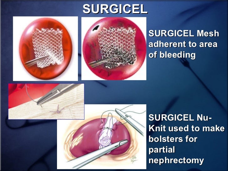 Use Of Tissue Sealants And Hemostatic Agents