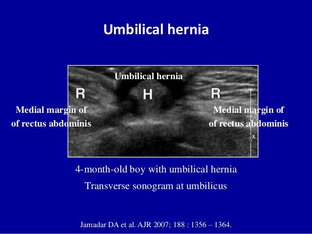 layers of abdominal wall umbilical hernia