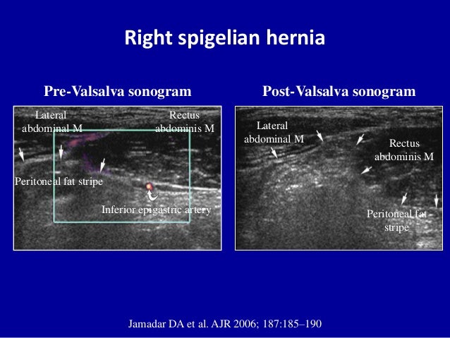 Ultrasound of the abdominal wall hernias