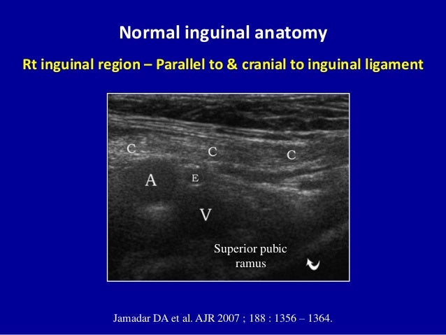 Ultrasound Pictures Of Inguinal Hernia 86